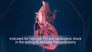 Pleural Fluid Puncture by USG Guide [upl. by Atiuqan]