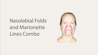 Face Taping for Nasolabial Folds and Marionette Lines [upl. by Kinnard]