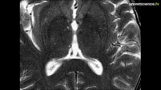 IRM structurelle  cerveau [upl. by Drareg]