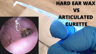 Hard Ear Wax VS Articulating Curette [upl. by Novahc]