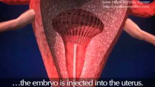 Embryo Transfer [upl. by Nehr]